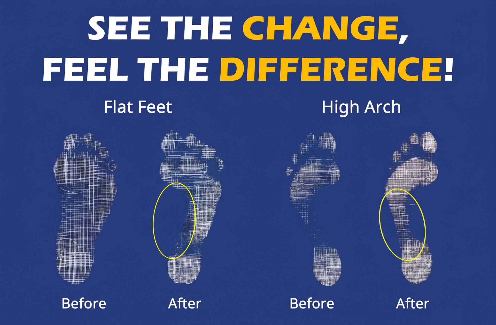 Before-and-after footprint scans for flat feet and high arches, showing more balanced arch contact after wearing JGP.